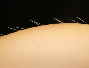 acupuncture